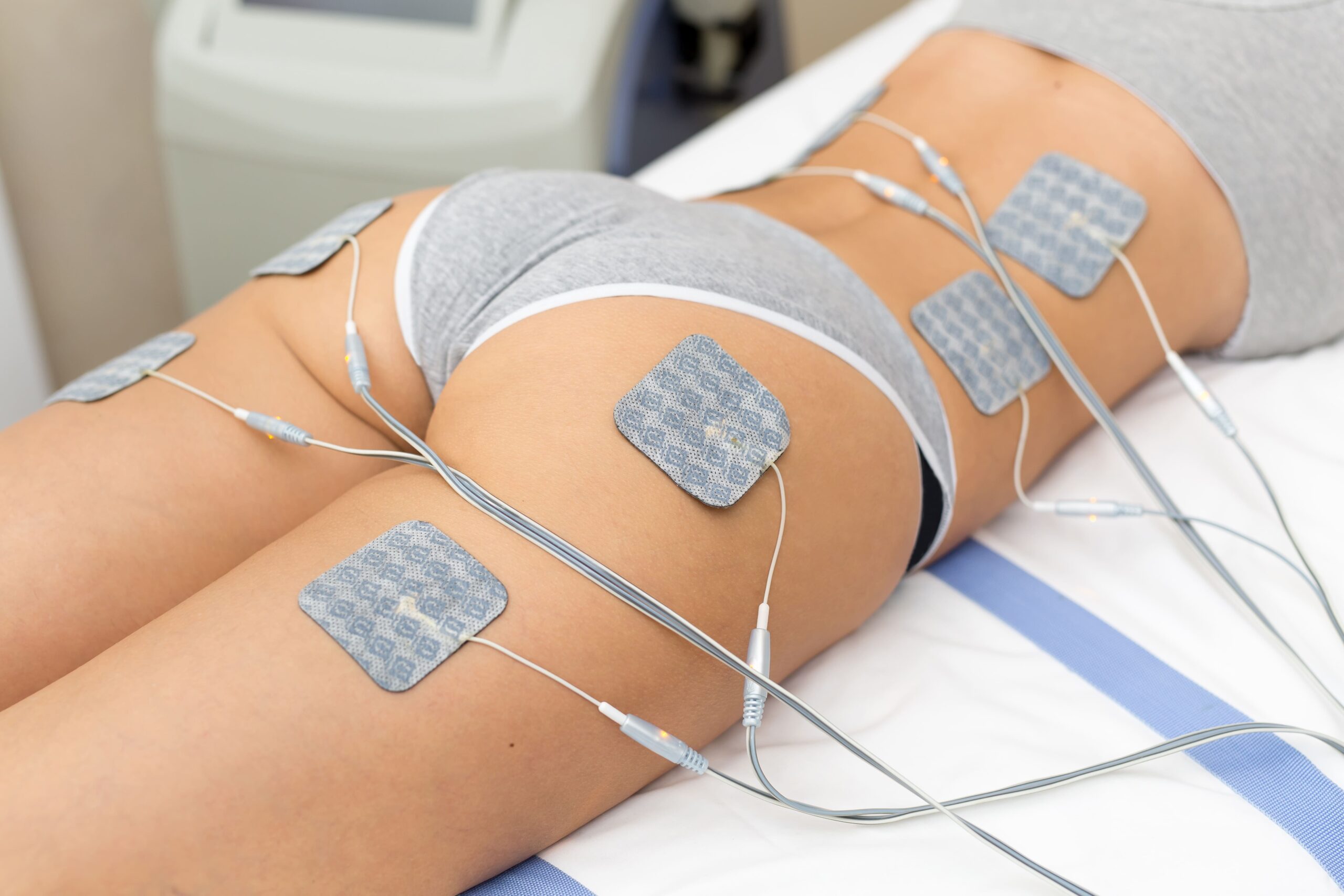 ELECTROESTIMULACIÓN